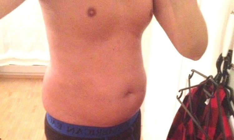 Fettabsaugung Unterbauch und beide Flanken - 26284