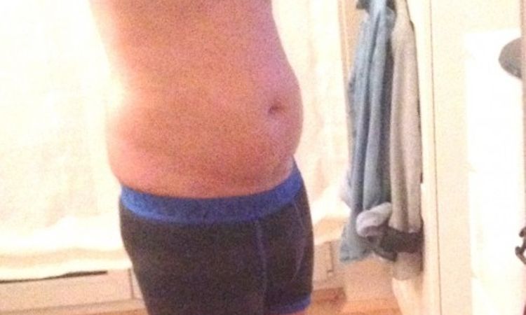 Fettabsaugung Unterbauch und beide Flanken - 26285