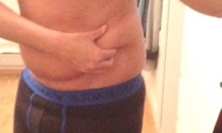 Fettabsaugung Unterbauch und beide Flanken - 26286