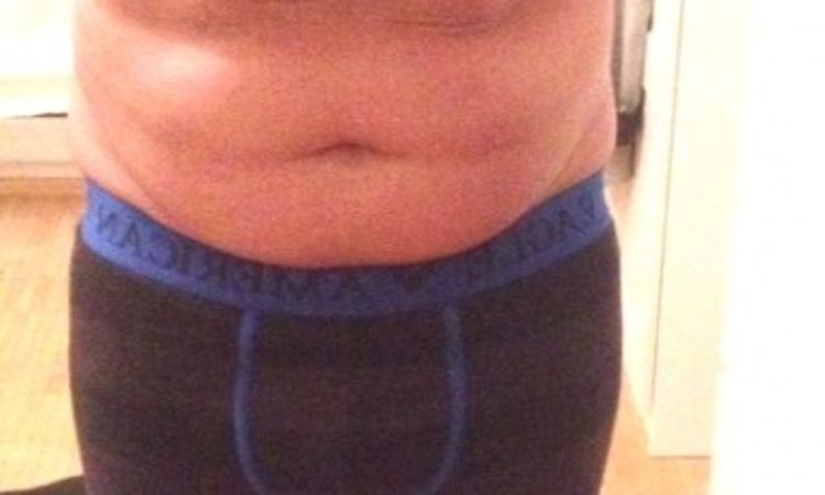 Fettabsaugung Unterbauch und beide Flanken - 26287