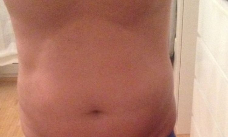 Fettabsaugung Unterbauch und beide Flanken - 26288