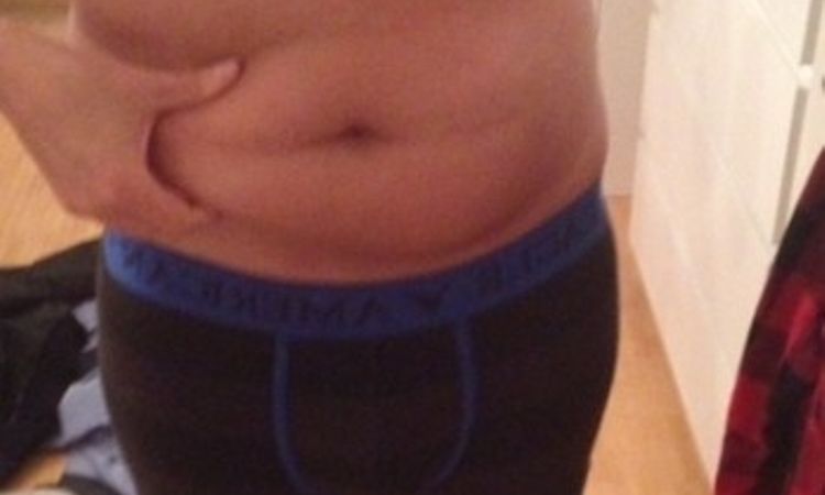 Fettabsaugung Unterbauch und beide Flanken - 26289