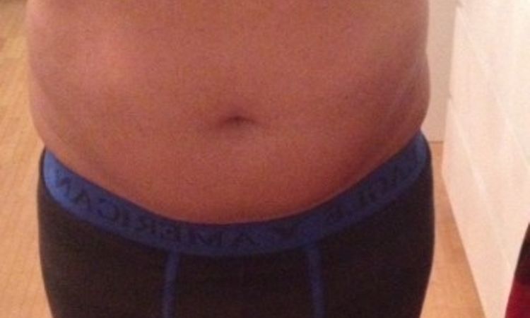 Fettabsaugung Unterbauch und beide Flanken - 26290