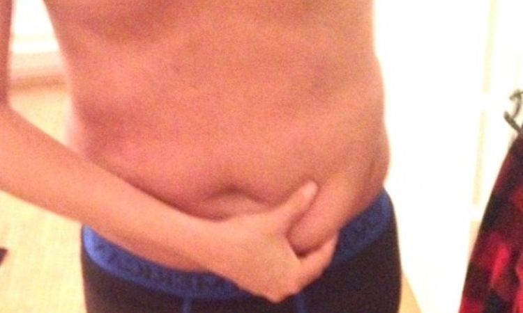 Fettabsaugung Unterbauch und beide Flanken - 26291