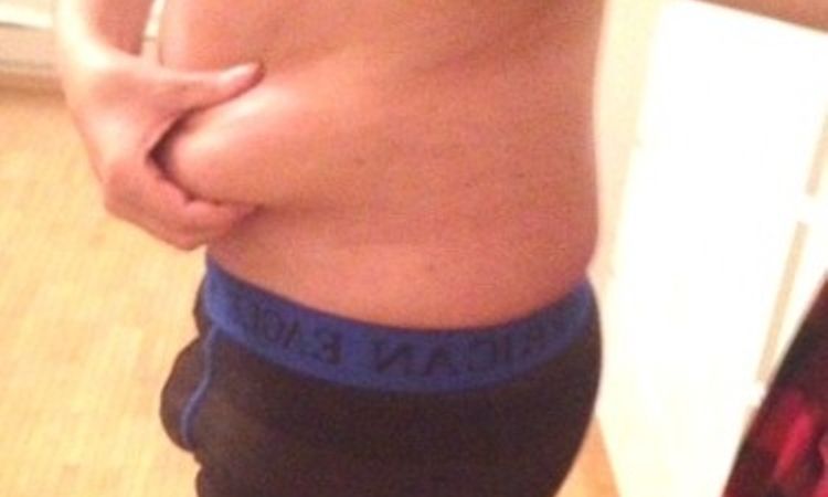 Fettabsaugung Unterbauch und beide Flanken - 26292