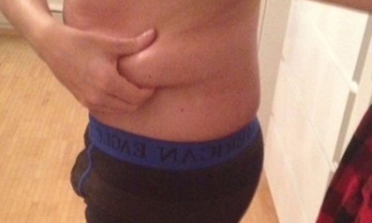 Fettabsaugung Unterbauch und beide Flanken - 26293