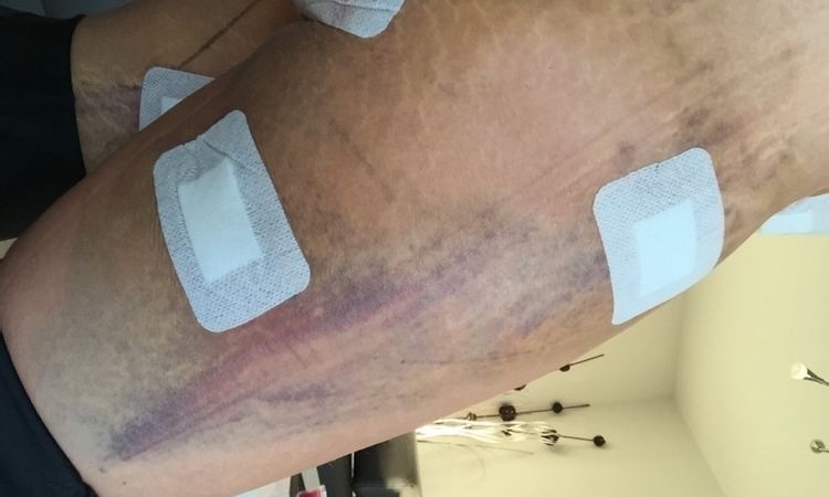 Kreislaufprobleme nach Liposuktion - 26317