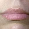 Lippenvergrößerung in Wien oder Tschechien - 26332