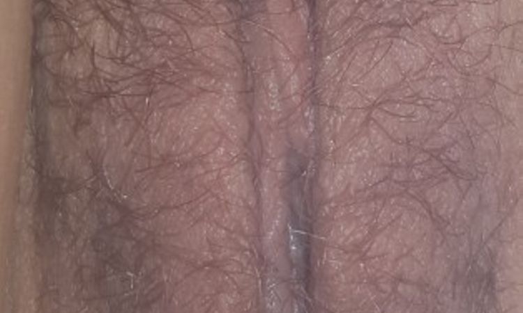 Schwellung nach Schamlippenverkleinerung - 26335