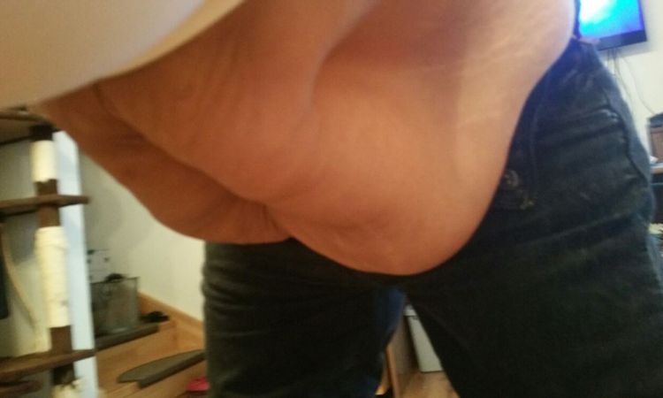 Bauchstraffung mit T-Schnitt - 26357