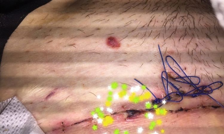 Blase nach Bauchdeckenstraffung mit Rektusdiastaseverschluss - 26361