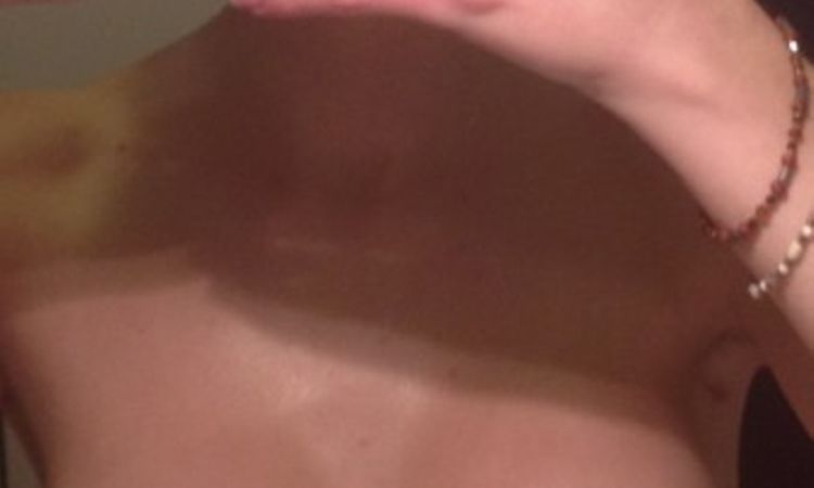 Implantat sitzt nach Brustvergrößerung zu tief - 26383