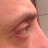 Behandlung von aufgerissenen Augen mit Eigenfett - 26388