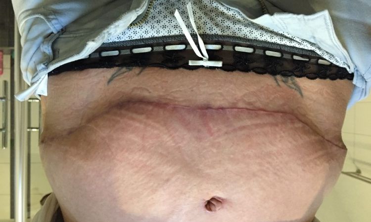 Verhärtungen zwischen Narbe und Nabel nach Bauchdeckenstraffung mit Nabelversetzung - 26402