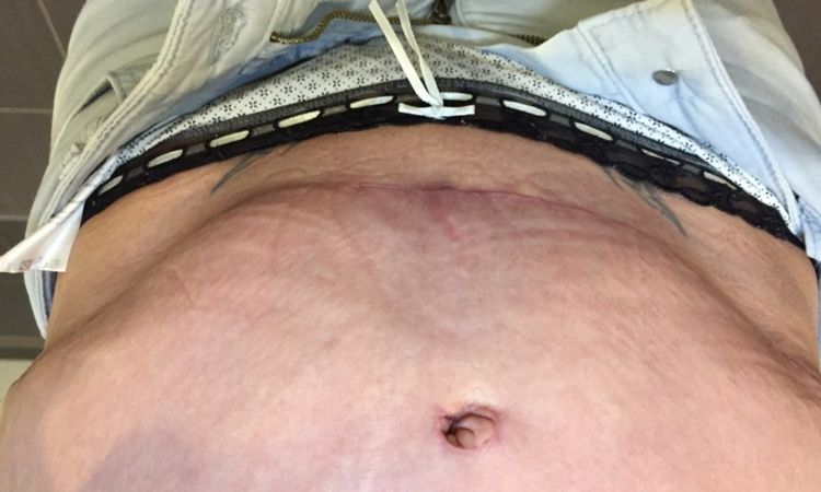 Verhärtungen zwischen Narbe und Nabel nach Bauchdeckenstraffung mit Nabelversetzung - 26403