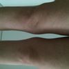 Ergebnis der Fettabsaugung an Knien und Bauchdeckenstraffung - 26418