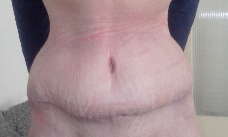 Wird der Bauch nach Bauchdeckenstraffung wieder so flach? - 26443