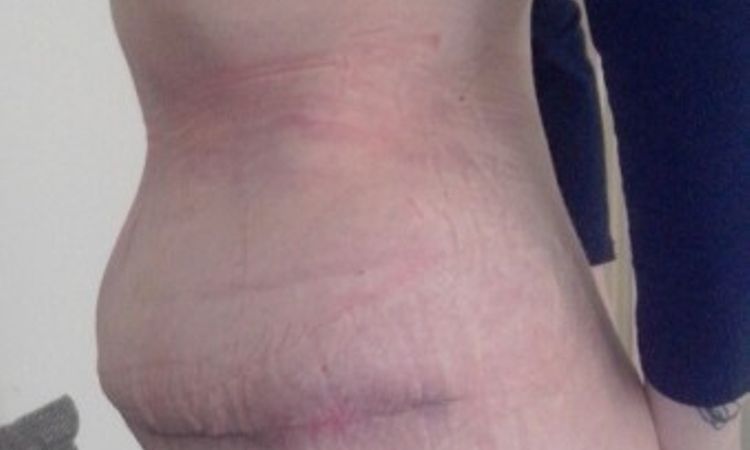 Wird der Bauch nach Bauchdeckenstraffung wieder so flach? - 26444