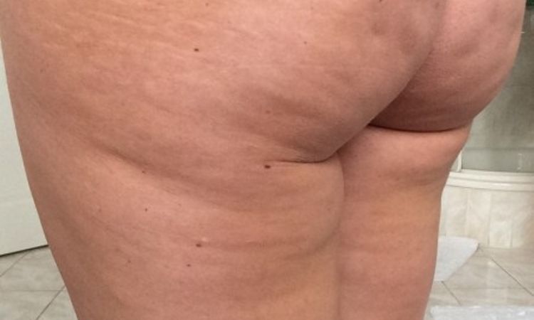 Behandlung von Cellulite nach Fettabsaugung - 26450