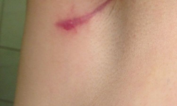 Narbenpflege nach Brustvergrößerung durch die Achsel - 26455