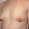 Tuberöse Brust