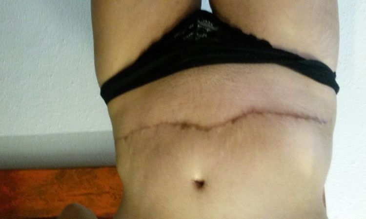 Behandlung der Narbe nach Bauchdeckenstraffung - 26487