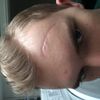 Behandlung der Narbe an der Stirn - 26491