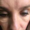 Behandlung der schlaffen Haut unter den Augen - 26493
