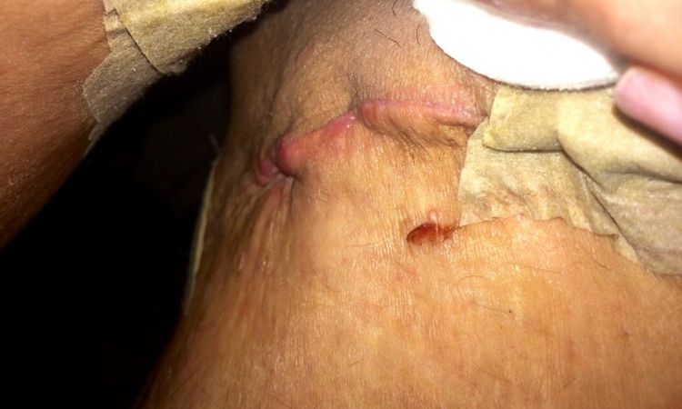 Narbenprobleme in der Heilungsphase nach Oberschenkelstraffung - 26516
