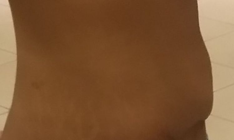 Stufenbildung nach Bauchdeckenstraffung - 26524