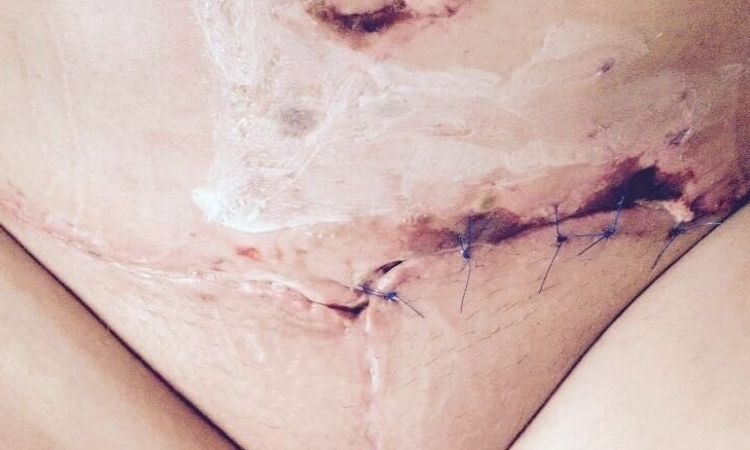 Schwarzes Gewebe nach Fettabsaugung am Bauch und Venushügel - 26538