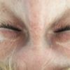 Was kann ich gegen weiße Narben nach Augenlidkorrektur tun? - 26589