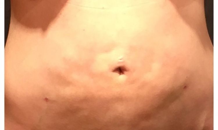 Unebenheiten am Bauch 19 Tage nach Fettabsaugung - 26622