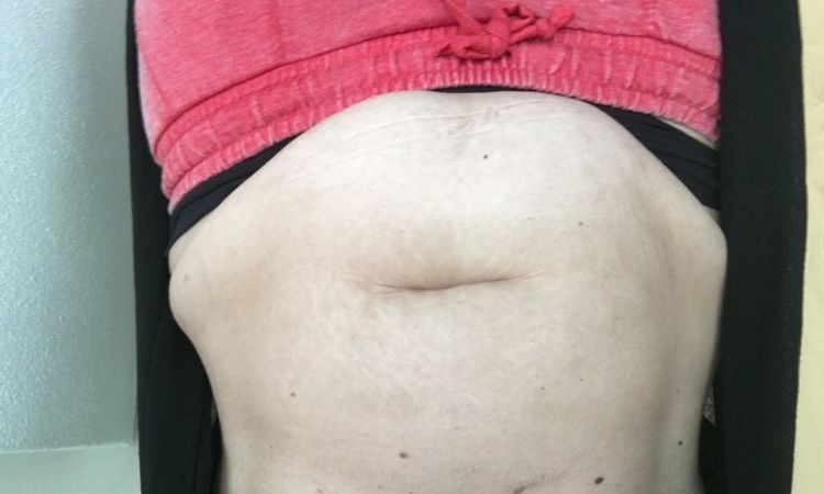 Laser zur Behandlung der Fettschürze geeignet?  - 26628