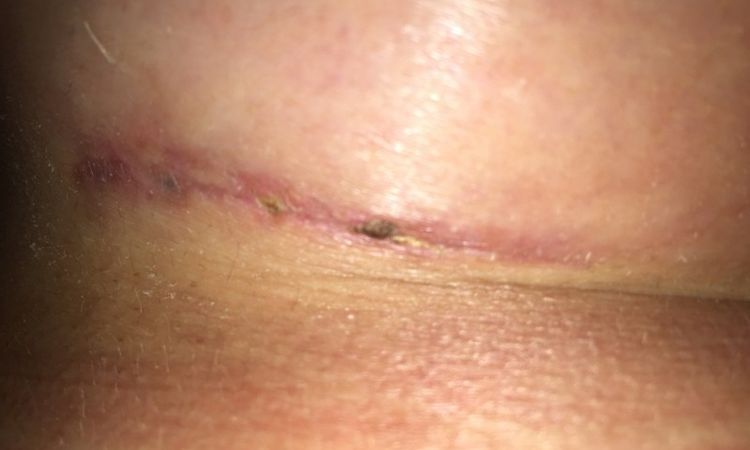 Kleiner blauer Fleck bei der Narbe 6 Wochen nach Brustvergrößerung - 26634