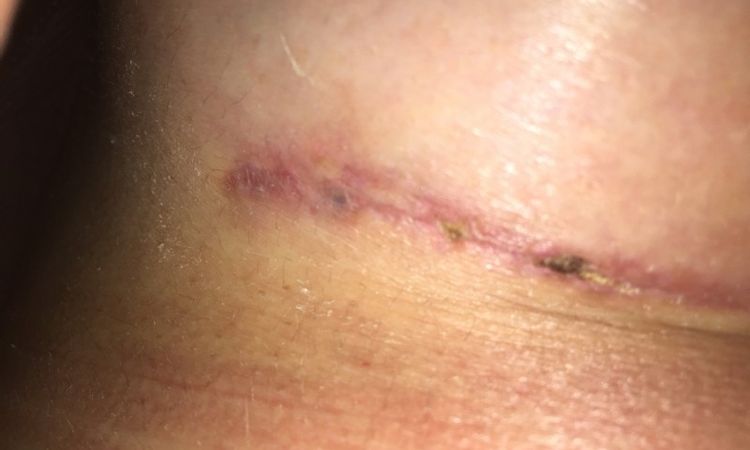 Kleiner blauer Fleck bei der Narbe 6 Wochen nach Brustvergrößerung - 26635