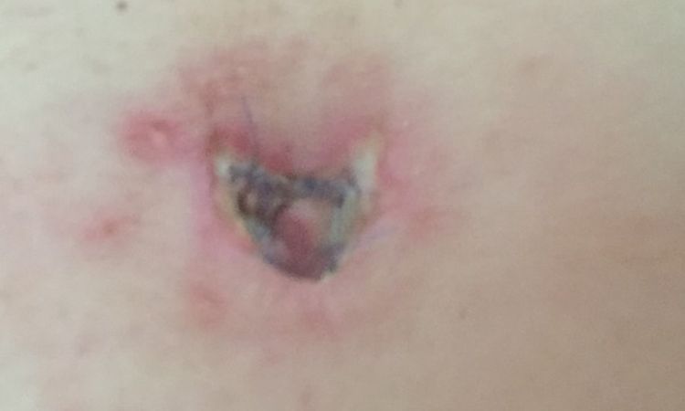 Bauchnabelnekrose 8 Tage nach Abdominoplastik - 26645
