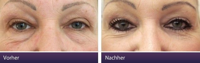 Microdermabrasion gegen Tränenfurche bei Face-Lift