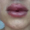 Lippen aufgespritzt mit 0,5ml Hyaluronsäure - 26669