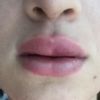 Lippen aufgespritzt mit 0,5ml Hyaluronsäure - 26670