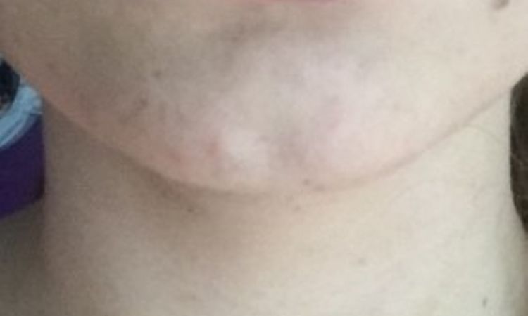 Lippen aufgespritzt mit 0,5ml Hyaluronsäure - 26670