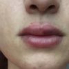Lippen aufgespritzt mit 0,5ml Hyaluronsäure - 26672