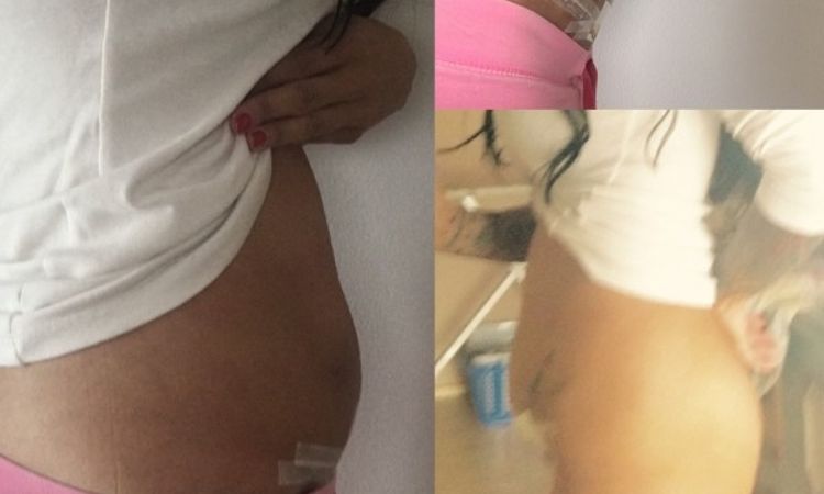 2 Wochen nach Minibauchstraffung mit Fettabsaugung 200 ml - 26674
