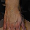Lipofilling oder Sklerotisation an der Hand - 26675