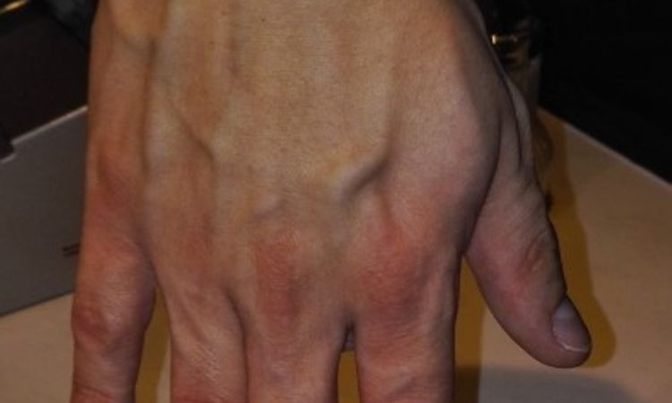 Lipofilling oder Sklerotisation an der Hand - 26675