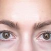 Endoskopisches Augenbrauenlifting mit 30 Jahren - 26696