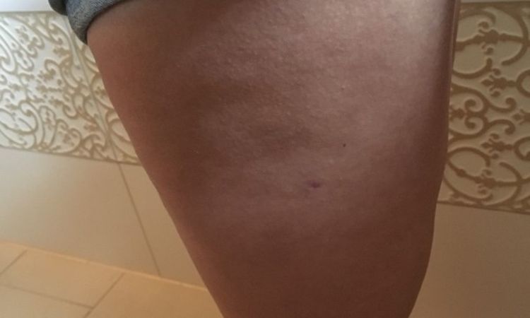 Unebenheiten 8 Wochen post Oberschenkel-Liposuktion - 26700