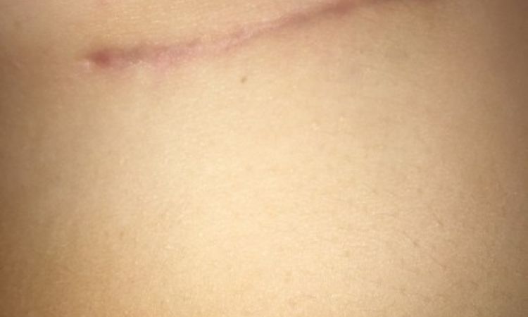Narben 3 Monate nach Brustvergrößerung - 26744