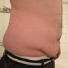 Bauchdeckenstraffung nach Gewichtsabnahme von 40 kg - unzufrieden mit Hüften - 26749