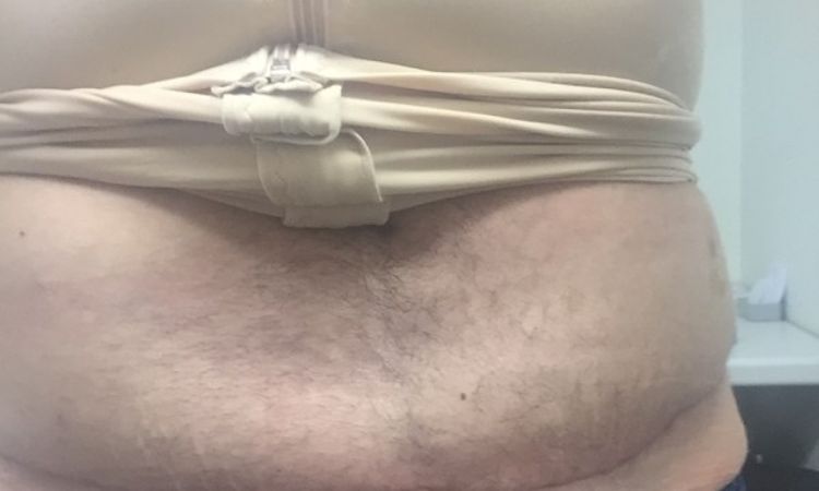 Unebene zwischen Bauch und Schambereich 6 Wochen nach Bauchdeckenstraffung - 26766